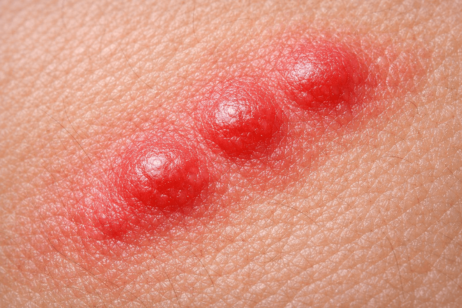 Macro close-up of bed bug bites showing red welts and inflammation on skin