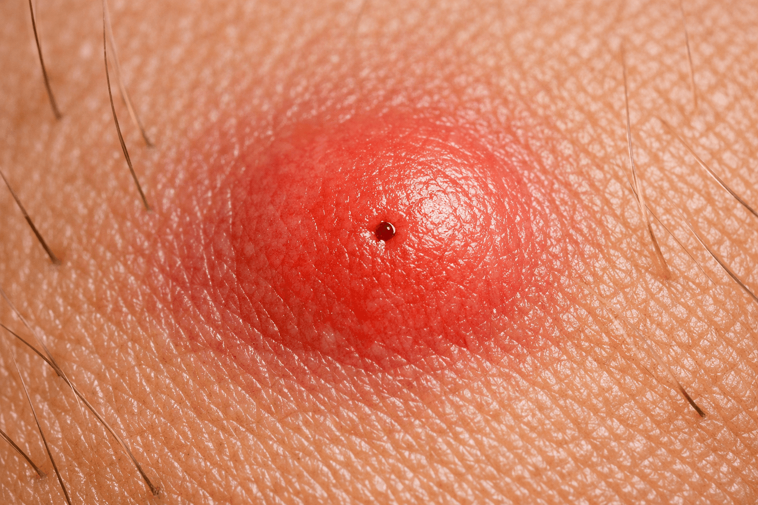 Close-up macro photo of mosquito bite on skin showing red swelling and inflammation detail