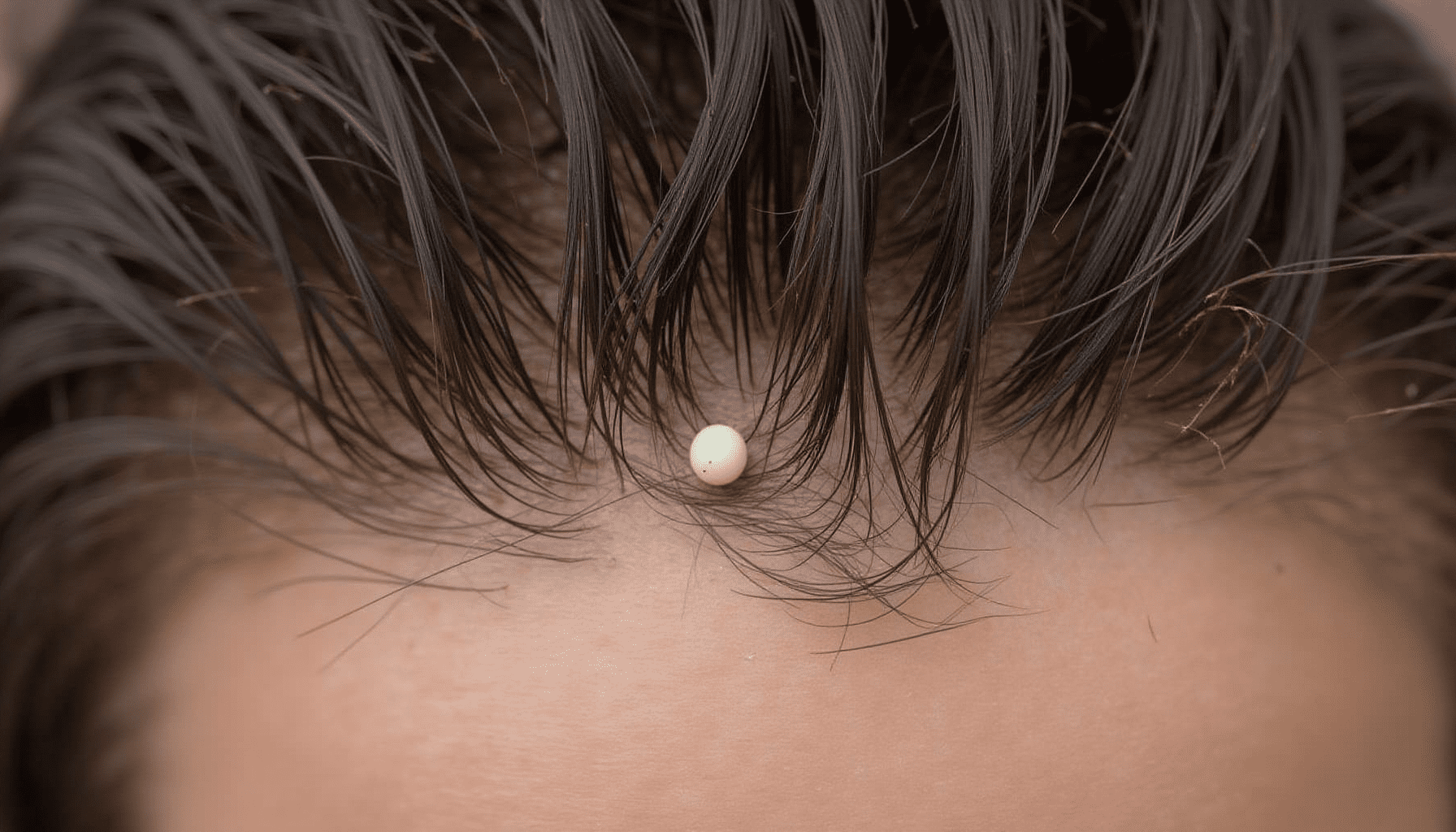 Close-up of a human scalp with dark hair, showing several head lice eggs (nits) and a small nymph for context.